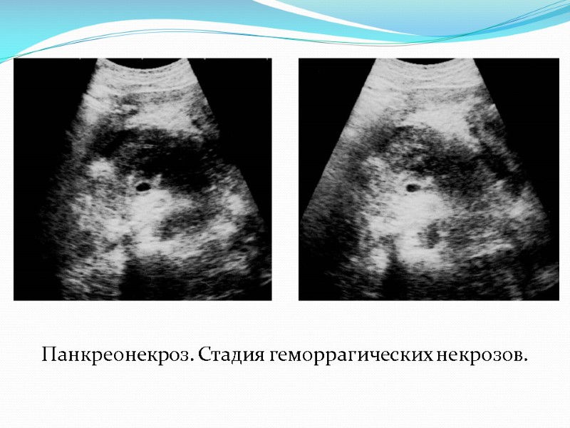 Панкреонекроз. Стадия геморрагических некрозов.